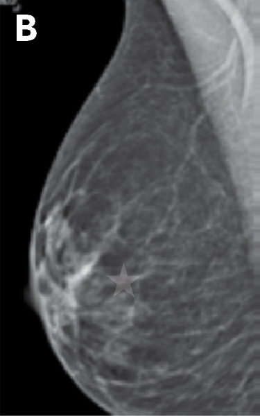 Scattered areas of fibroglandular density